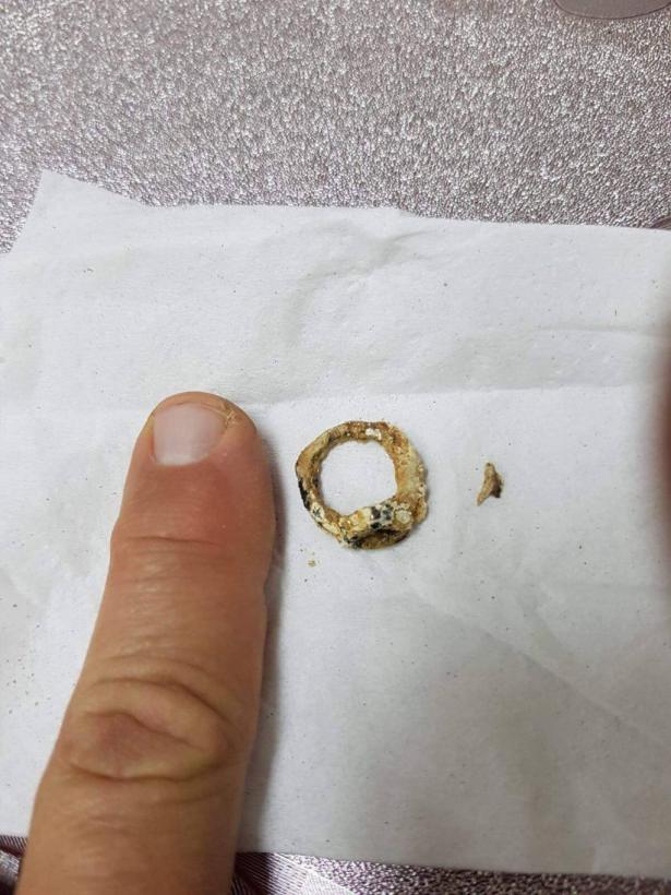 طمرة: إستخراج خاتم علق لمدة سنتين في أنف فتاه وسبب لها التلوث