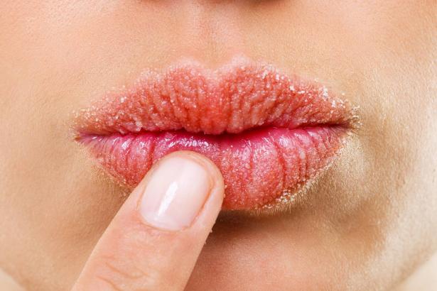 8 مكوّنات طبيعيّة كافية لتخليصنا من مشكلة تشقّق الشفاه