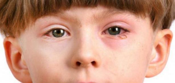 التهاب الملتحمة أو الرمد عند الأطفال