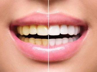 علاجات تبييض الأسنان