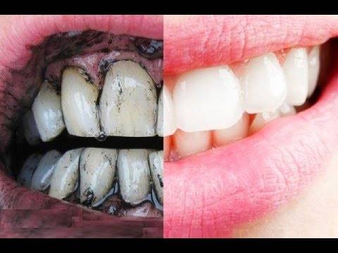 علاج المنزل: طرق تبييض الأسنان