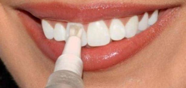 متابعة الرعاية بعد تبييض الأسنان العلاج