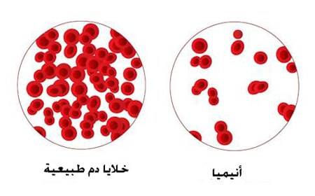 فقر الدم (Anemia )