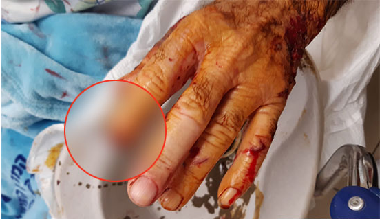 كلب مسعور يقطع اصبع مسن عربي في نهاريا