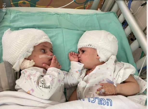د.تساحي لازر مدير قسم العلاج المكثف في مستسفى سوروكا وعملية فصل راس توأمين
