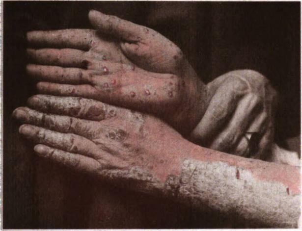 بواسطة George Henry Fox - Fox, George Henry (١٨٨٦) Photographic illustrations of skin diseases (٢. ed.), E.B. Treat Retrieved on 25 September 2010. وملكية عامة وhttps://commons.wikimedia.org/w/index.php?curid=11593519
