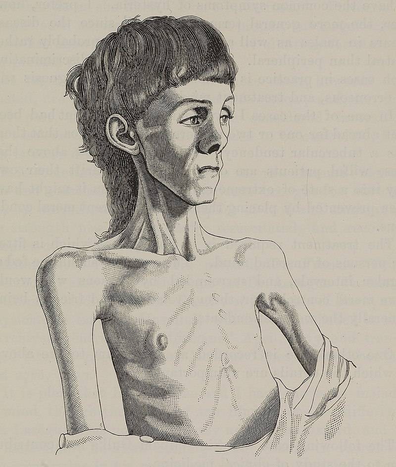 بواسطة https://wellcomeimages.org/indexplus/obf_images/aa/08/a3d6319bf70f8d3f73fbda88eed8.jpgGallery: https://wellcomeimages.org/indexplus/image/L0073694.htmlWellcome Collection gallery (2018-03-31): https://wellcomecollection.org/works/c2482zpx CC-BY-4.0 وCC BY 4.0 وhttps://commons.wikimedia.org/w/index.php?curid=75326466