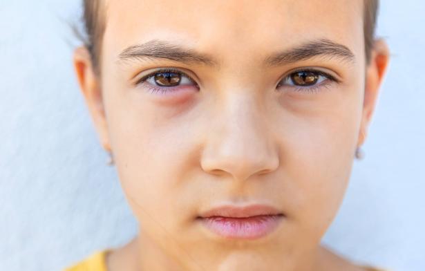 ما هو التهاب العيون وما علاقته بالشتاء؟