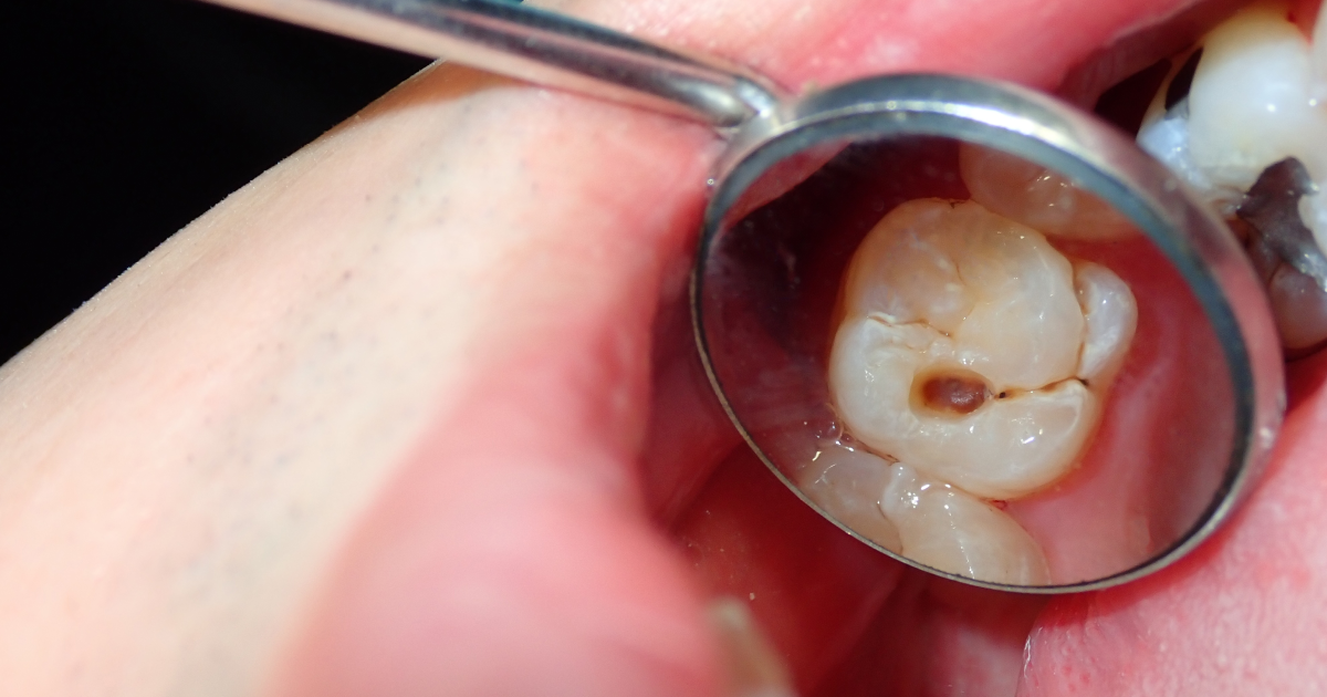 موجودة في المنزل: 4 علاجات طبيعية لتخفيف آلام الأسنان