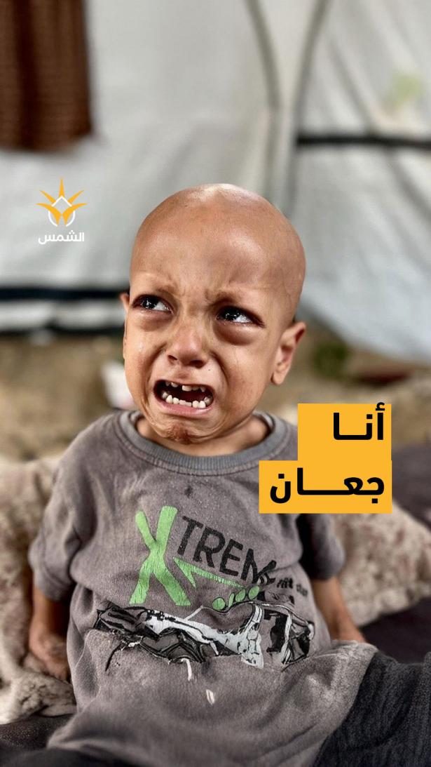 وفاة الطفل عبد الله أبو زرقة بعد معاناة مع الجوع وسوء التغذية
