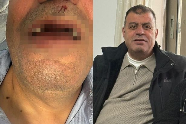 "خرجت أطلب رزقي وعدت بثمانية أسنان مكسورة".. سائق حافلة يروي لحظات الاعتداء عليه في القدس